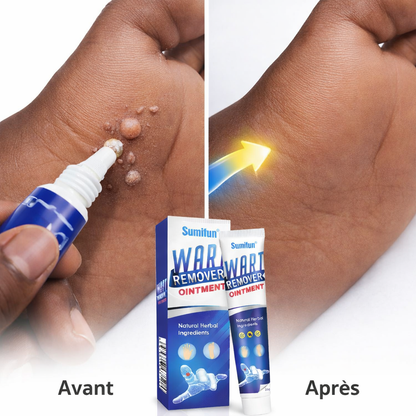 Crème anti verrues